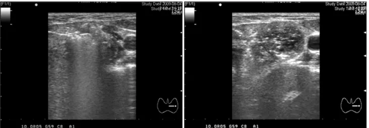 Fig. 2. Moving  shot  technique:  the  electrode  tip  was  moved  back  ward  in  order  to  prevent  heat  transmitting  to  the  perithyroidal  tissue
