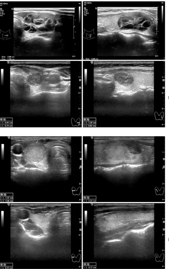 Fig. 5. A  21-year-old  woman  had  a  nodule  of  soft  solid  type. 