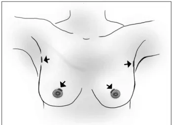 Fig.  1.  Location  of  skin  incision  in  endoscopic  thyroidectomy  via  bilateral  axillobreast  approach.