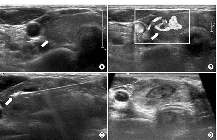 Fig.  1.  (A)  40-year-old  woman  (number  3  case)  had  a  solid  nodule  in  the  right  lobe  of  her  thyroid  gland