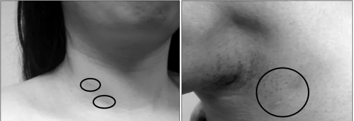 Fig.  2.  Endoscopic  thyroidectomy.
