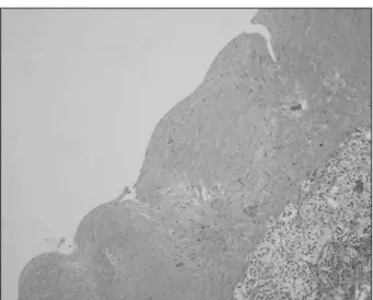 Fig.  2.  Microscopic  finding  demonstrates  cystic  wall  without  epithelial  lining