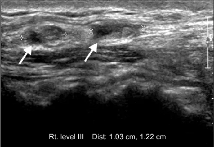 Fig.  1.  Preoperative  ultrasonographic  feature  of  nodules  at  the  right  level  III  area