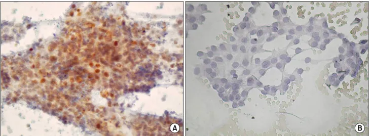 Fig. 1. Immunohistochemical  staining  for  p27  in  papillary  thyroid  cancer  cells  (×400)