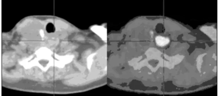Table  1.  Incidentally  detected  on  18F-FDG  PET-CT  and  under- under-going  further  diagnostic  confirmation