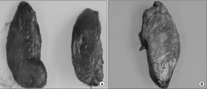 Fig.  3.  Gross  specimen  of  both  thyroid  DSPC.  (A)  This  thyroid  shows  firm  parenchyma
