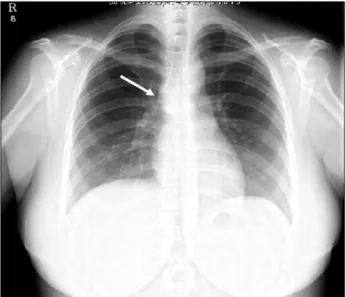 Fig.  1.  A  chest  PA  shows  bulging  contour  at  the  Rt.  upper  mediastinal  area  (white  arrow).
