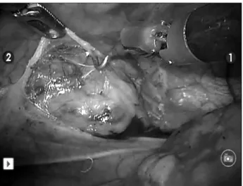 Fig.  4.  Dissection  of  mediastinal  lymph  node  using  Da  vinci  robotic  system
