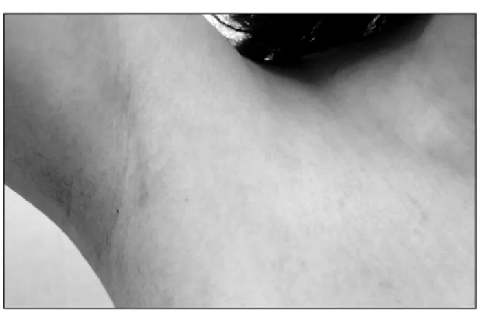 Fig.  3.  The  excellent  cosmetic  benefit  in  the  gasless  endoscopic  thyroidectomy  using  trans-axillary  approach  (The  operation  scar  is  faintly  identified  at  the  axillary  area  3  months  after  the  operation).