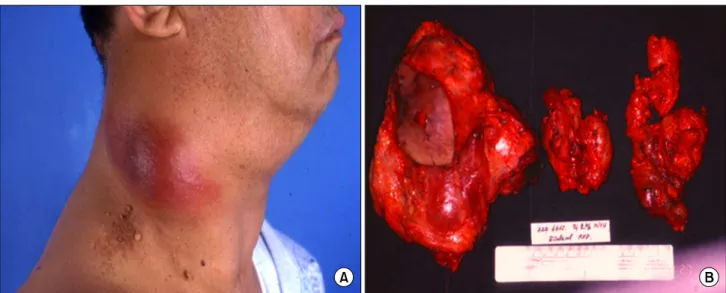 Fig.  1.  Specimen  of  case  1.  (A)  Rapid  growing  mass  in  right  lateral  cervical  area  and  (B)  gross  specimen  after  second  operation  for  recurrent  thyroid  carcinoma  showing  anaplastic  transformation.