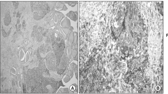 Fig. 3. Ultrasonography of right thyroid gland. Shows two solid  nodules with heterogenous echo.