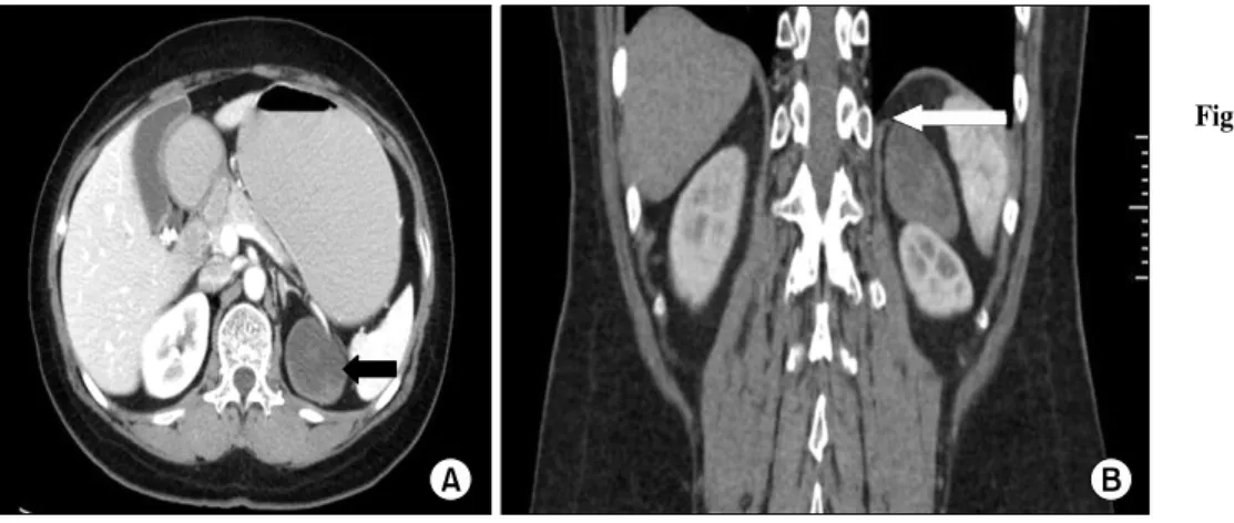 Fig. 1. Abdominal  computed  tomo- tomo-graphy  scan.  (A)  Axial  CT  finding.  There  was  a  6×4  cm  sized  mass  with  low  density  located  at  the  superior  pole  of  the  left  adrenal  gland  (black  arrow)