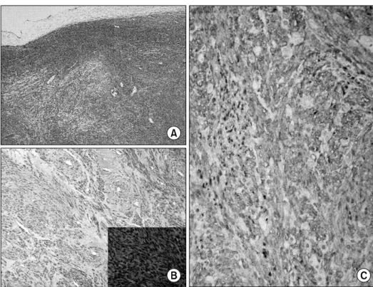 Fig. 3. Microscopic  and  immuno- immuno-histochemical  findings.  (A)  The  tumor  was  a  well  circumscribed  mass,  mostly  composed  of  spindle  cells  without  normal  adrenal   struc-tures  (H&amp;E,  ×20)