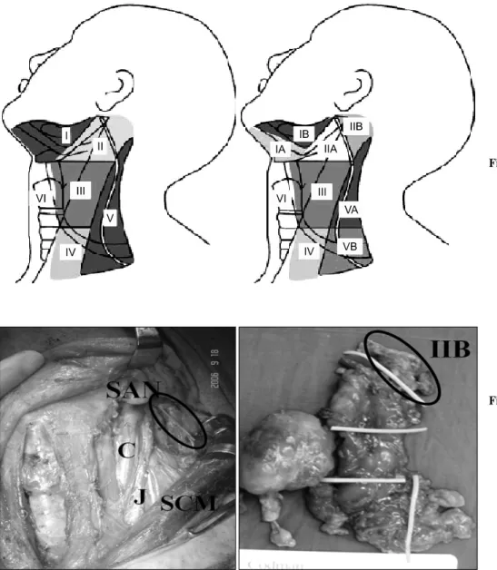 Fig.  1.  Anatomic  classification  of  cervical  lymph  node  drainage.  (A)  Memorial  Sloan-Kettering  Cancer  Center  leveling  system  of  cervical  lymph  nodes