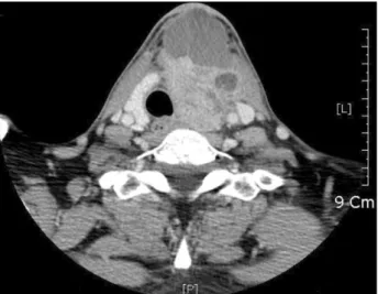 Fig.  4.  Total  thyroidectomy  specimen.  Partial  portion  of  strap  mus- mus-cle  and  subcutaneous  tissue  were  removed  altogether.
