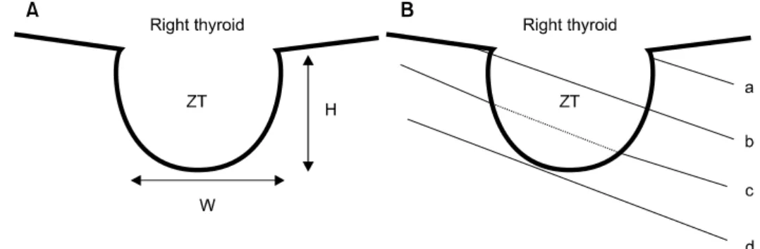 Fig.  1.  The  measurement  of  ZT  size  (A)  and  classification  of  relationship  between  the  ZT  and  the  RLN  (B)