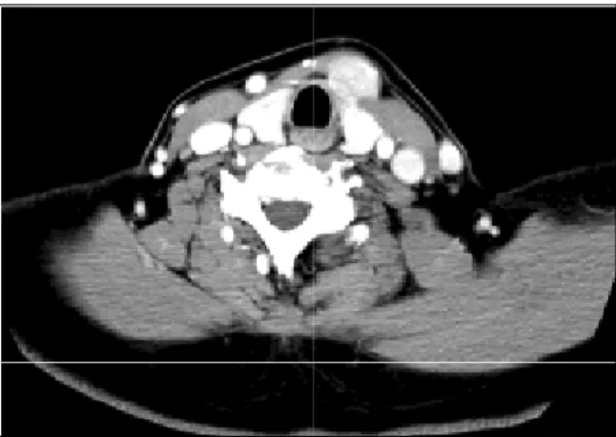 Fig.  1.  Neck  CT  shows  1.2×2.6×2.3  cm-sized  hypervascular  mass  at  left  thyroid  gland.