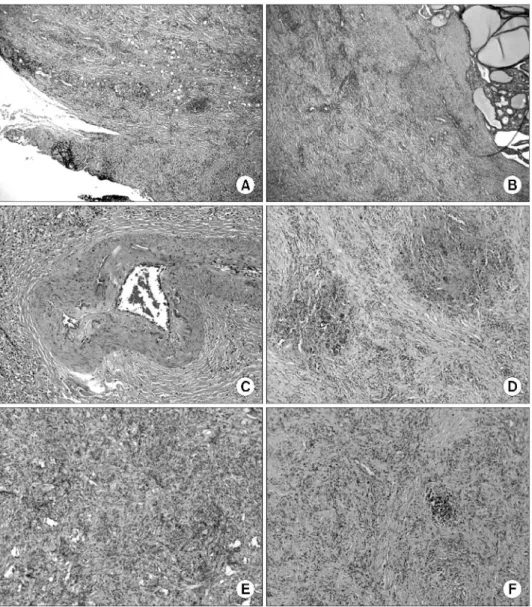 Fig. 2. Microscopic findings of the resected left lobe of thyroid gland (H&amp;E stain: A∼C;
