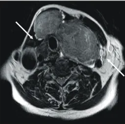 Fig.  1.  MRI  of  the  neck.  Upper  trachea  is  displaced  to  the  right  side  and  left  internal  jugular  vein  with  tumor  thrombus  shows  poor  patency.