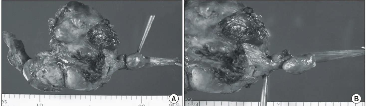 Fig.  2.  Venous  phase  of  neck  MR  angiography.  10×5×5  cm  sized  multilobulated  hypervascular  mass  in  left  thyroid  gland  with  surrounding  vascular  engorgement