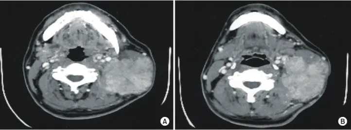 Fig.  3.  Computerized  tomography  findings.  (A)  Invasion  to  SCM  muscle.  (B)  Invasion  of  posterior  scaleneus  muscle  in  preverteveral  area.