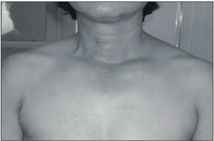 Fig.  5.  The  appearance  of  the  patient  who  underwent  endoscopic  thyroidectomy  by  the  axillary  approach.