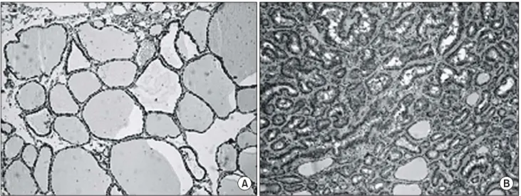 Fig.  1.  Immunohistochemical  staining  for  hsp70  in  normal  thyroid  tissue  (A)  and  papillary  carcinoma  tissue  (B)  (×100  for  A  and  ×40  for  B).