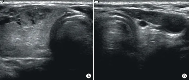 Fig.  1.  (A)  A  transverse  sonogram  of  the  isthmic  thyroid  gland  shows  a  2.0  cm  sized  heterogenous  echoic  mass