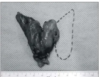 Fig.  3.  The  operative  findings  shows  the  complete  absence  of  left  thyroid  lobe.