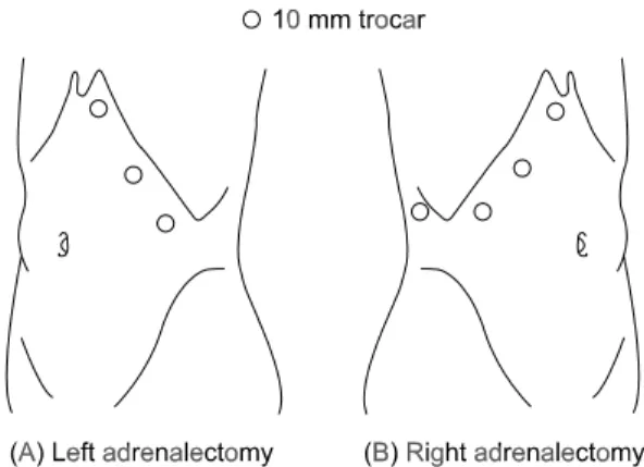 Fig.  1.  Trocar  sites  for  laparoscopic  adrenalectomy.
