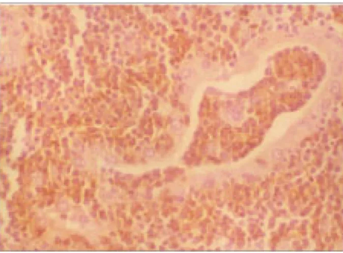 Fig.  3.  A  lymphoepithelial  lesion  is  seen  in  the  upper.  It  is  a  thyroid  follicle  infiltrated  and  expanded  by  lymphoid  cells  (H&amp;E,  ×400).