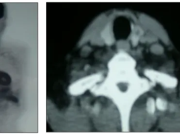 Fig.  1.  FDG-PET  scan:  A  hot  uptake  in  left  neck  area. Fig.  2.  Neck  CT  scan  showing  a  1cm  sized  lower  dencity  nodule  in  left  lobe  of  thyroid  gland  with  no  enlarged  LNs.