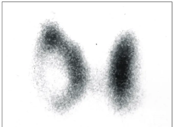 Fig.  1.  Hot  nodule  on  nuclear  scintigraphy.  Tc-99m  pertechnetate  scan  shows  a  solitary  mass  with  high  uptake  in  the  left  thyroid  gland