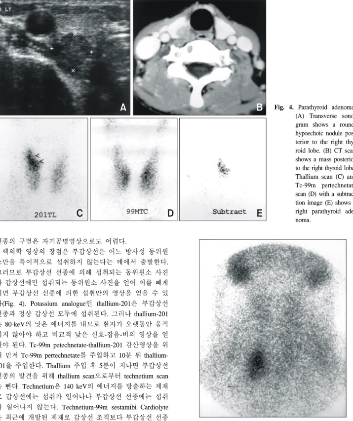 Fig.  5.  Parathyroid  adenoma  Anterior  view  of  Tc-99m  sestamibi  scan  demonstrates  a  right  parathyroid  adenoma.
