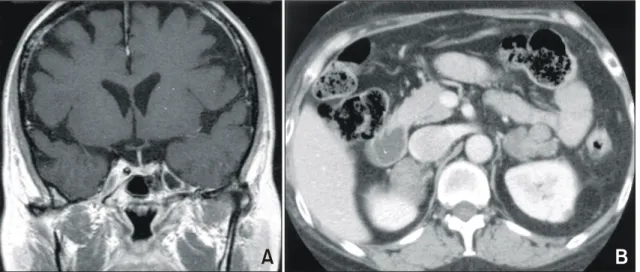 Fig.  7.  Cushing's  syndrome  with  bilateral  nodular  adrenal  hyperplasia.  (A)  T1-weighted  coronal  image  of  the  sella  after  contrast  infusion  shows  a  microadenoma  in  the  left  side  of  the  pituitary  gland
