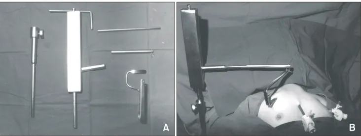 Fig.  2.  5  mm  laparoscopic  scope  shows  the  recurrent  laryngeal  nerve  (arrow)  with  traction  of  thyroidal  parenchymal  tissue.