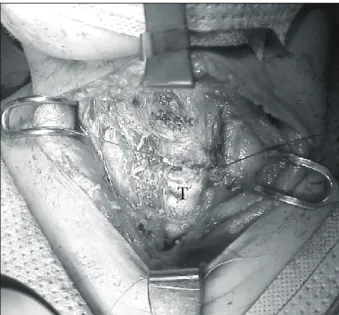 Fig.  5.  Repaired  trachea  by  interrupted  sutures  with  3-0  vicryl; 