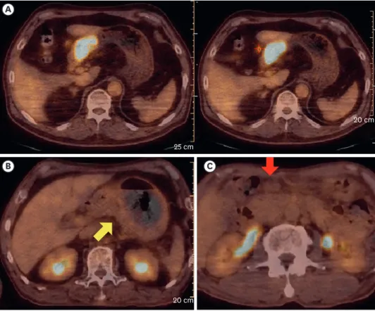 Fig. 1. Representative cases of  18 F-FDG-avid primary tumor (A, left) and LNs (A, right), non-avid primary tumor  (B), and non-avid LN (C)