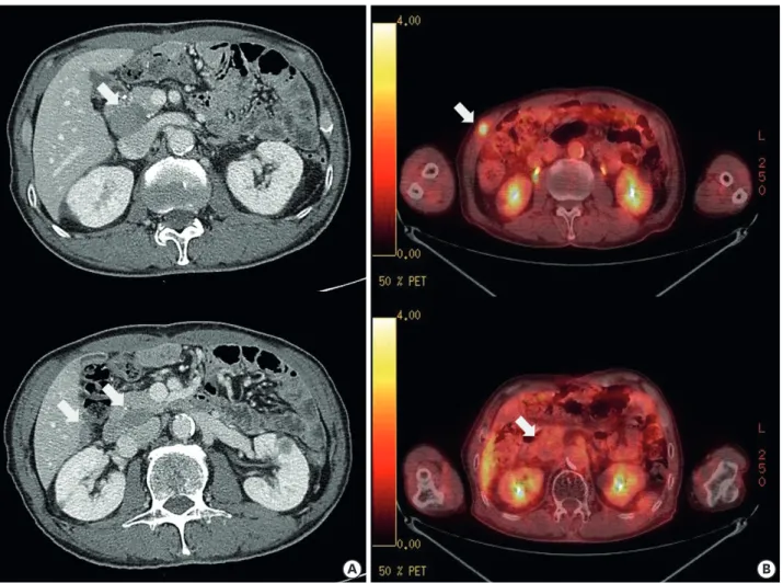 Fig. 2. CT and PET scan at second recurrence to the abdominal wall. (A) CT of the abdomen revealed a 1-cm enhancing mass at the right abdominal wall