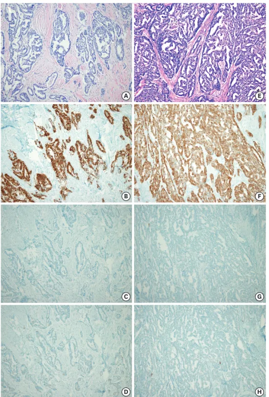 Fig. 3. Pathologic features of the abdominal wall mass (A-D) and the gastric tumor (E-H) obtained by surgical resection