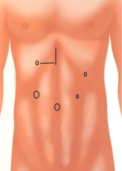Fig. 1. Locations of ports and mini-laparotomy wounds (right upper quadrant or upper midline) of laparoscopy- laparoscopy-assisted distal gastrectomy.