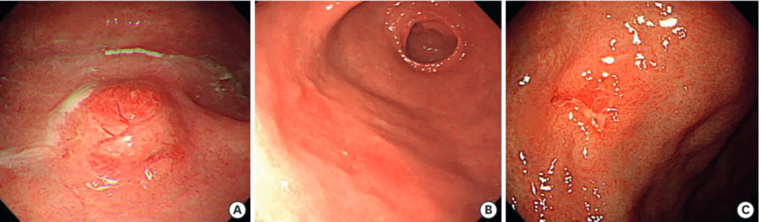 Fig. 1. Macroscopic type lesions of early GCLS. (A) A 10-mm subepithelial tumor-like lesion on the high body (elevated type)
