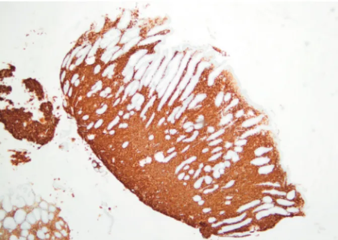 Fig. 2. Diffuse interstitial infiltration by large lymphoid cells, CD20+, CD10-, and cyclin D1 (H&amp;E, ×100).