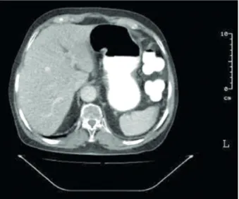 Fig. 4. Computed tomography scan of the abdomen 4 months after completion of chemotherapy showing  complete resolution of the previously noted gastric tumor.