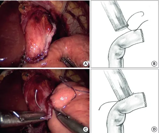 Fig. 2. Two-layer hand-sewn EJ. First posterior layer: a 34-Fr bougie is placed inside the esophagus (A)
