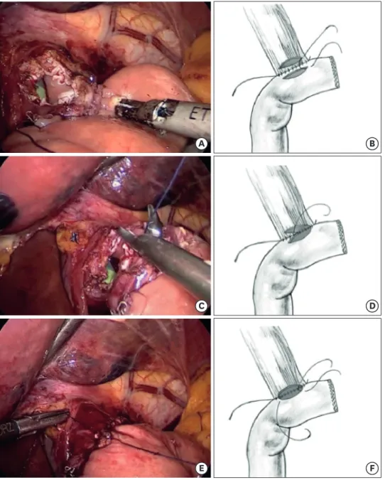 Fig. 3. Two-layer hand-sewn EJ. The second posterior layer and the first anterior layer: the anterior esophageal  wall is opened immediately above the stapler line and an enterotomy is also created in the jejunum (A)