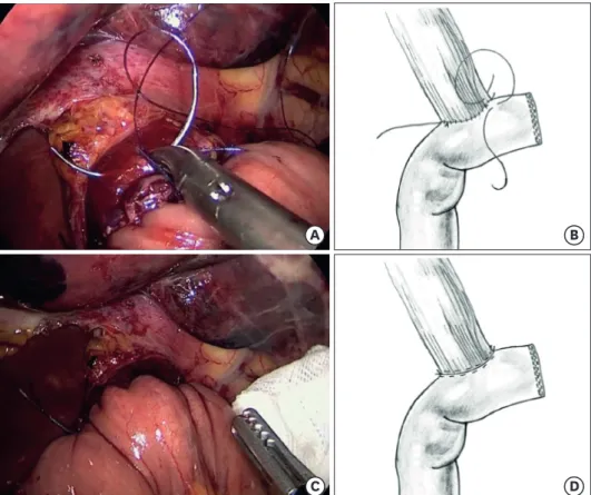 Fig. 4. Two-layer hand-sewn EJ. A second anterior layer is formed (A, B) and the anastomosis is completed (C, D)