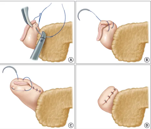 Fig. 1. Continuous LARS with invagination. At the upper end of the duodenal stump, a triangular suture with a  barbed suture is performed (A)