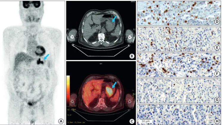 Fig. 1. Representative images of  18 F-FDG PET-CT and immunohistochemical staining for TILs