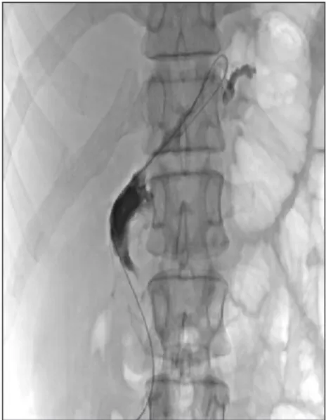 Fig. 1. Abdominal computed tomography scan showing duodenal 
